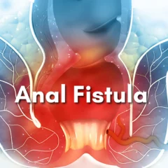 Fistula in ano: What, how and what to do