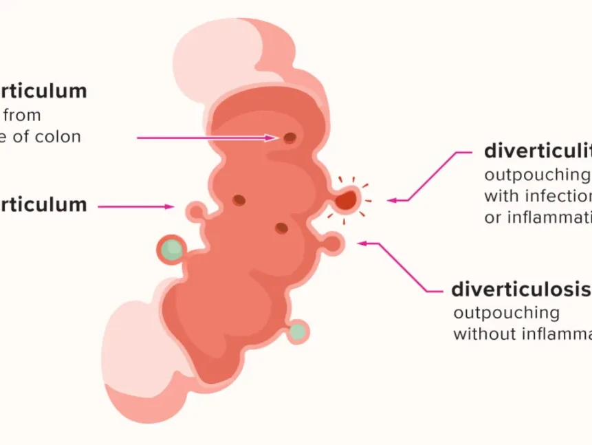 You are currently viewing Pouches in Your Colon: What You Need to Know About Diverticular Disease