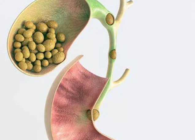 Gallstones: The Hidden Menace in Your Belly