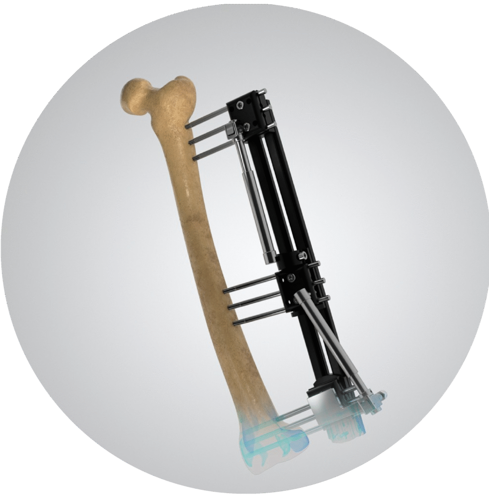 Institute of Limb Reconstruction in Mysore – avantbkg hospitals