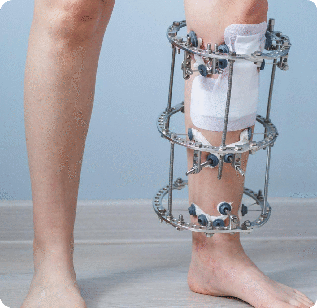 Institute of Limb Reconstruction in Mysore – avantbkg hospitals