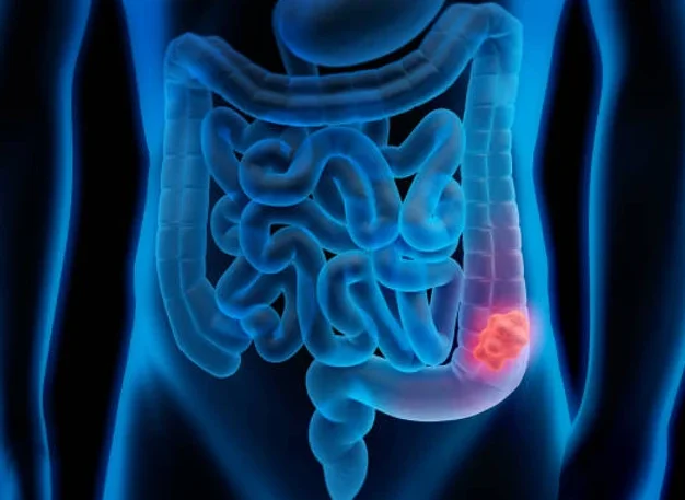 Colorectal Cancer: A silent killer that can be stopped