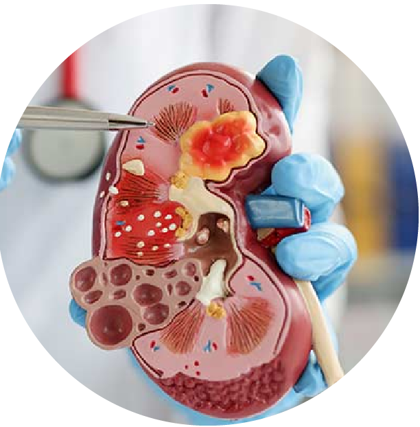 Best Nephrology Hospital in Mysore – avantbkg hospitals